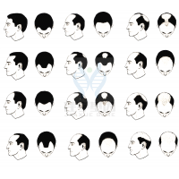 【Ebpay基因检测】过早<font color='red'>脱发</font>、掉发太多怎么办？你的方法可能是错的！